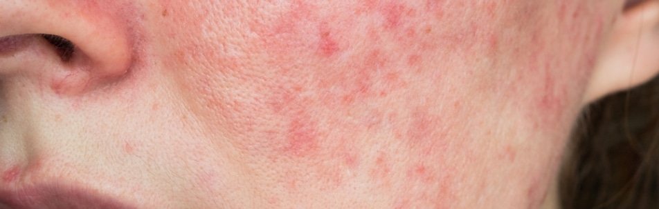 Rosacea
