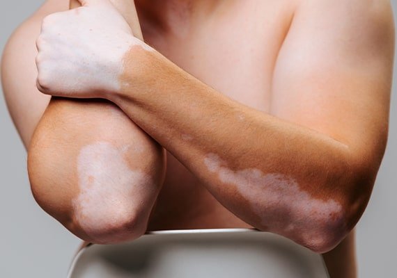 Vitiligo