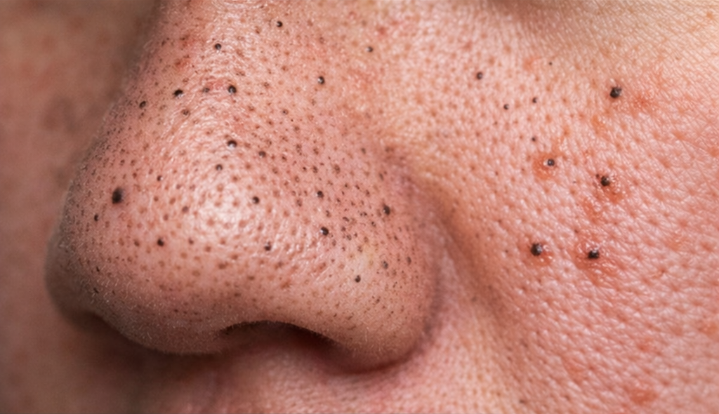 Acne example
