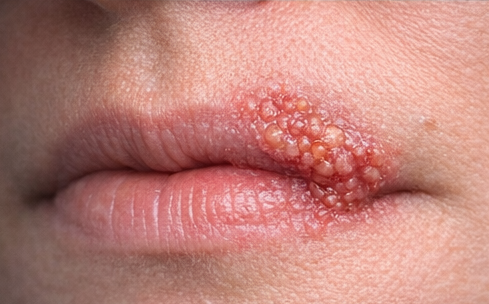 Cold Sores example