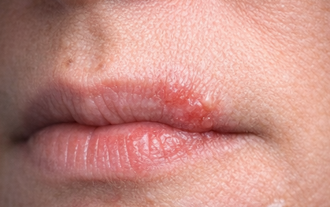 Cold Sores example