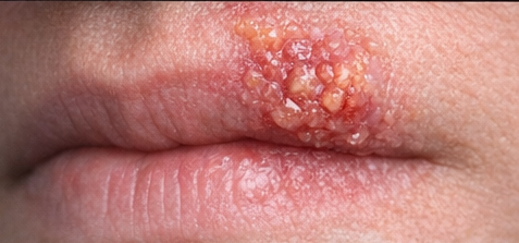 Cold Sores example