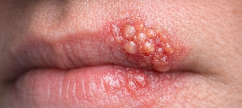 Cold Sores example