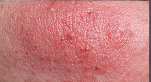 Dermatitis example