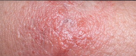 Dermatitis example