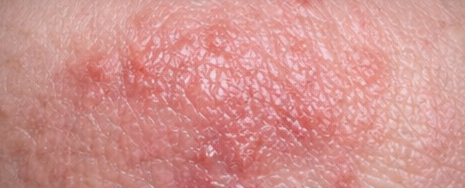 Dermatitis example
