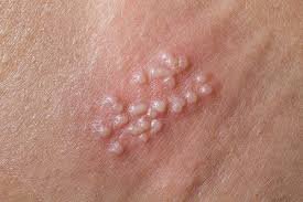 Genital Warts example