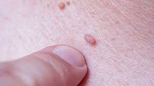 Genital Warts example