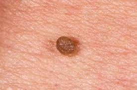 Genital Warts example