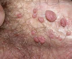 Genital Warts example