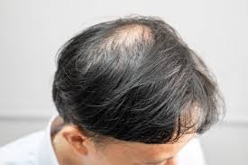 Hair Loss example