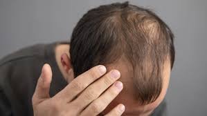 Hair Loss example