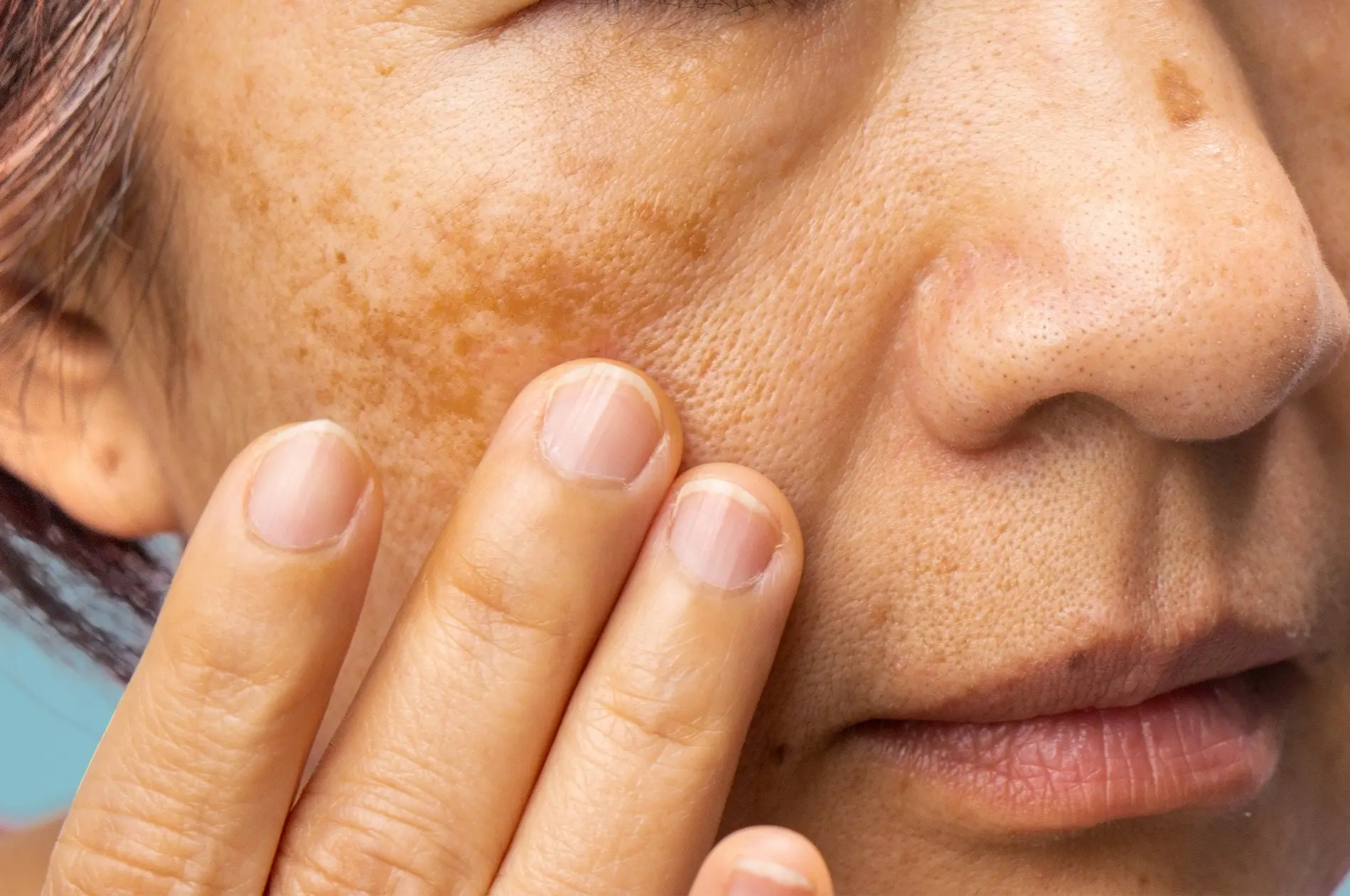 Melasma example