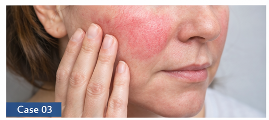 Rosacea example