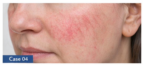 Rosacea example