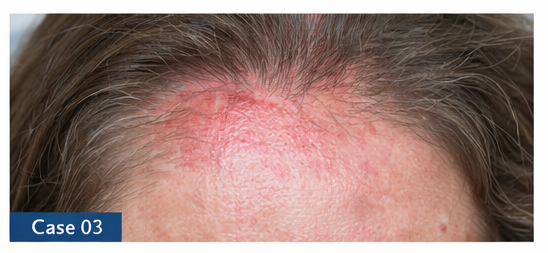 Scalp Conditions example