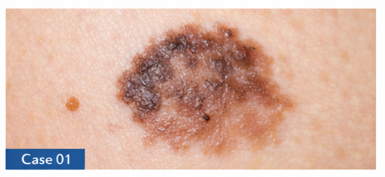 Skin Cancer Checks example