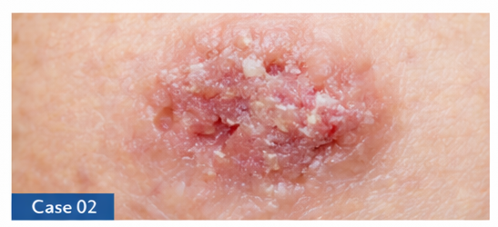 Skin Cancer Checks example