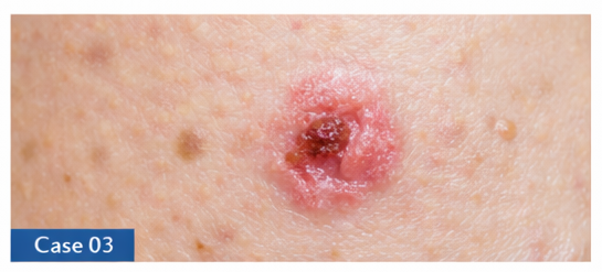 Skin Cancer Checks example