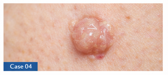 Skin Cancer Checks example