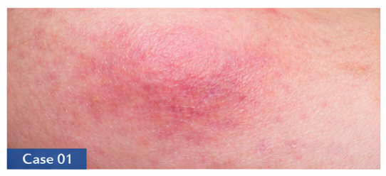 Skin Infections example