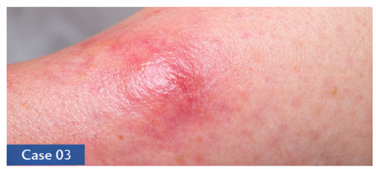 Skin Infections example