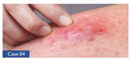 Skin Infections example
