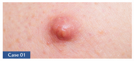 Skin Lesions example