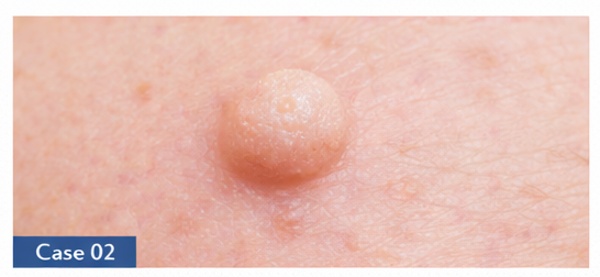 Skin Lesions example