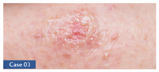 Skin Lesions example