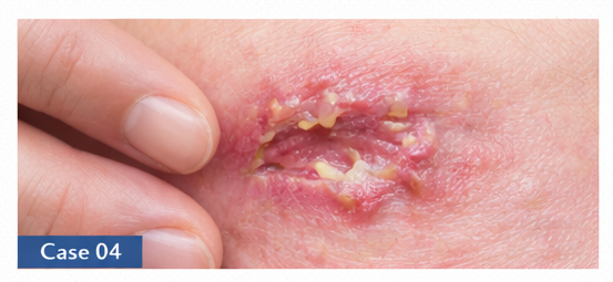 Skin Lesions example
