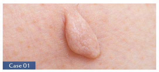 Skin Tags example