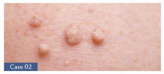 Skin Tags example