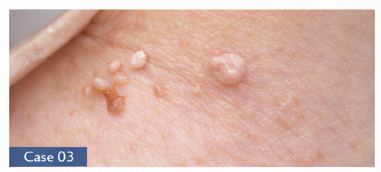 Skin Tags example