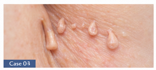 Skin Tags example