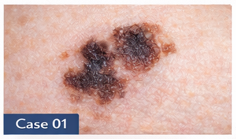 Suspicious Moles example