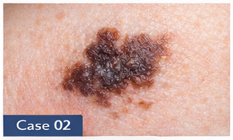 Suspicious Moles example