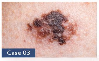 Suspicious Moles example