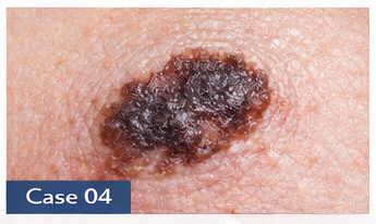 Suspicious Moles example