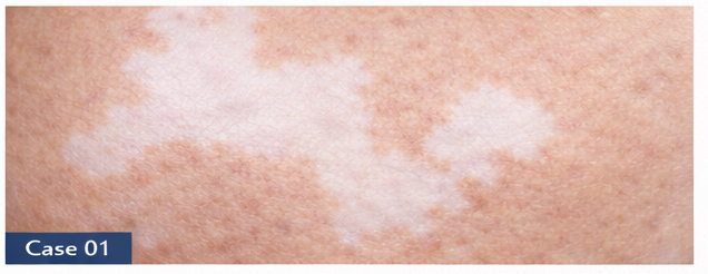 Vitiligo example