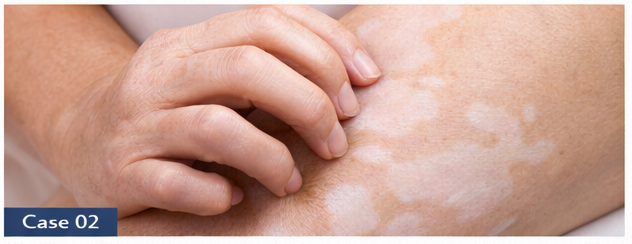 Vitiligo example