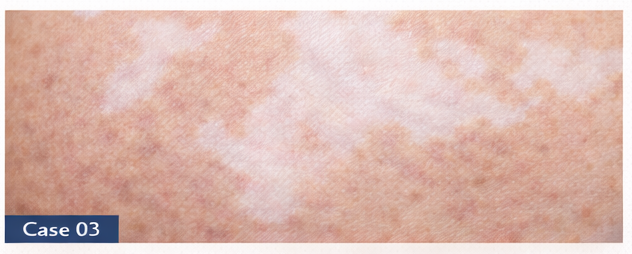 Vitiligo example