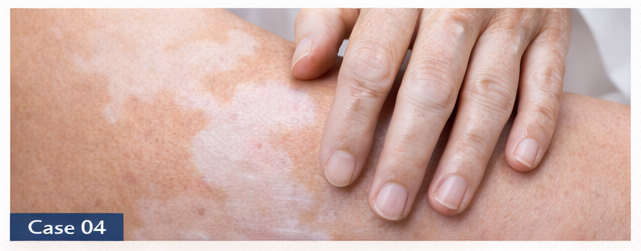 Vitiligo example