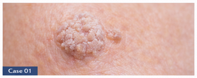 Warts example