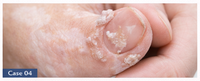 Warts example