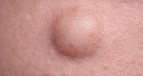 Cysts example