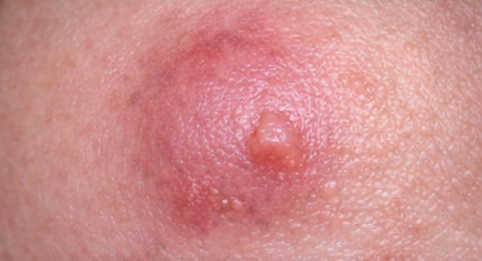 Cysts example